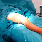 Sterile Abdeckung des gesamten Beines